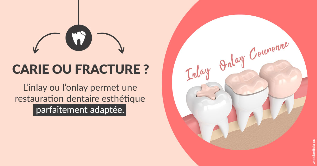 https://dr-sebbag-philippe.chirurgiens-dentistes.fr/T2 2023 - Carie ou fracture 2