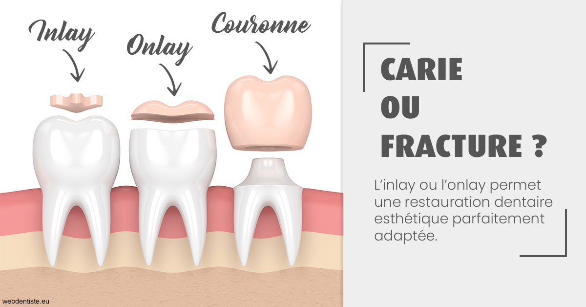 https://dr-sebbag-philippe.chirurgiens-dentistes.fr/T2 2023 - Carie ou fracture 1