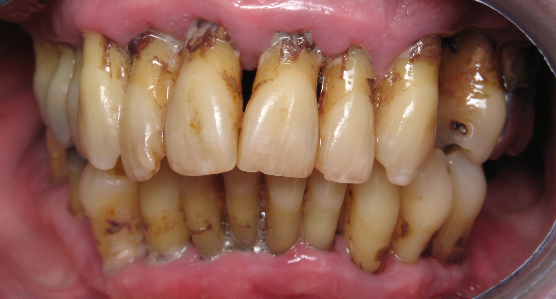1. état parodontal initial
